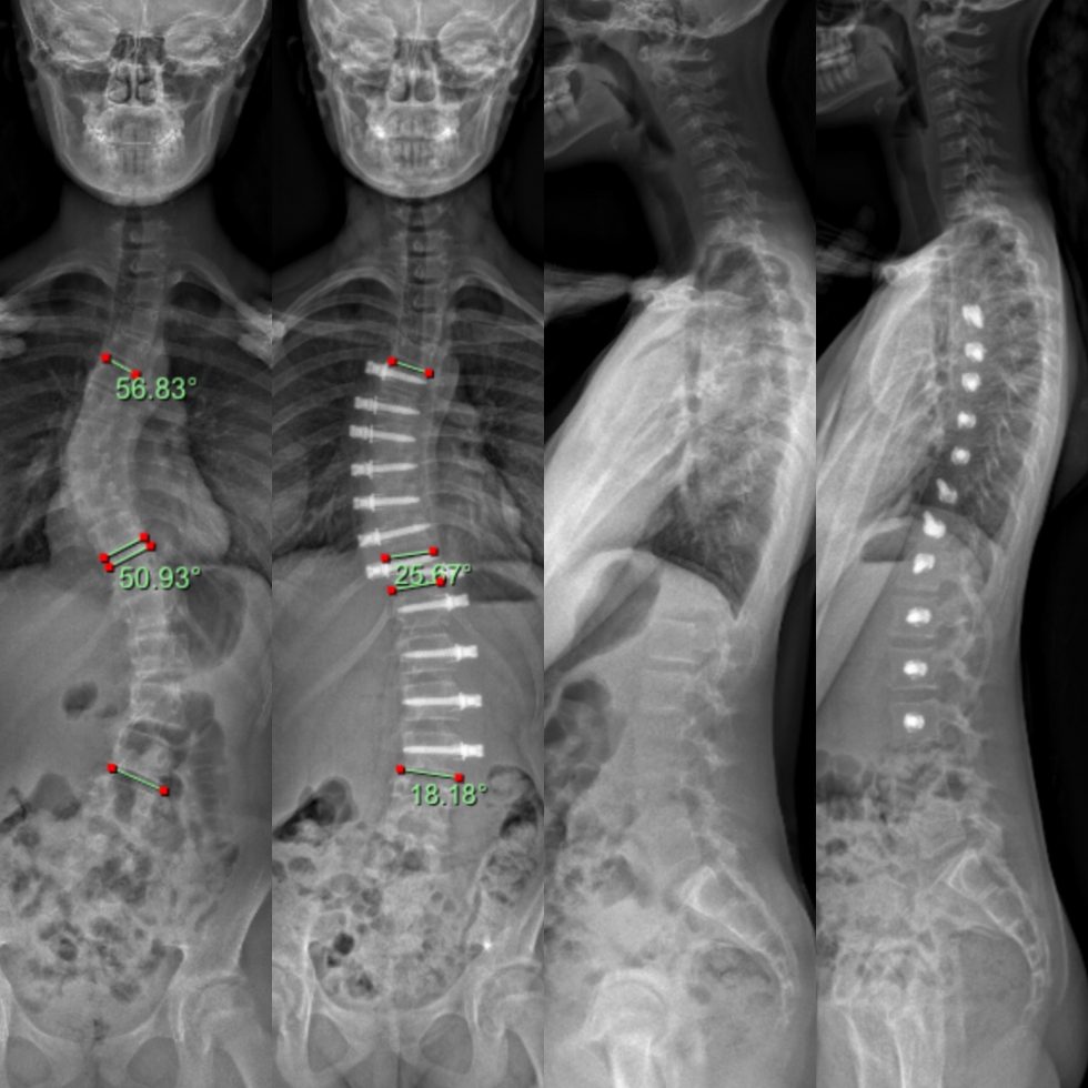 Scoliosis Surgery South Australian Scoliosis Service